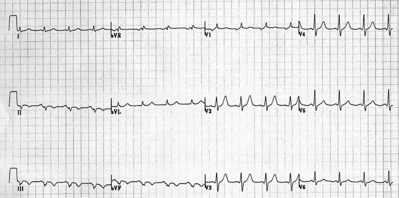 standard ecg